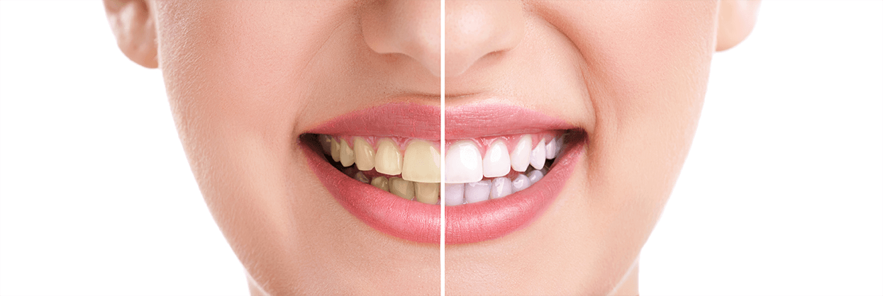 Teeth Whitening in Windermere, Florida